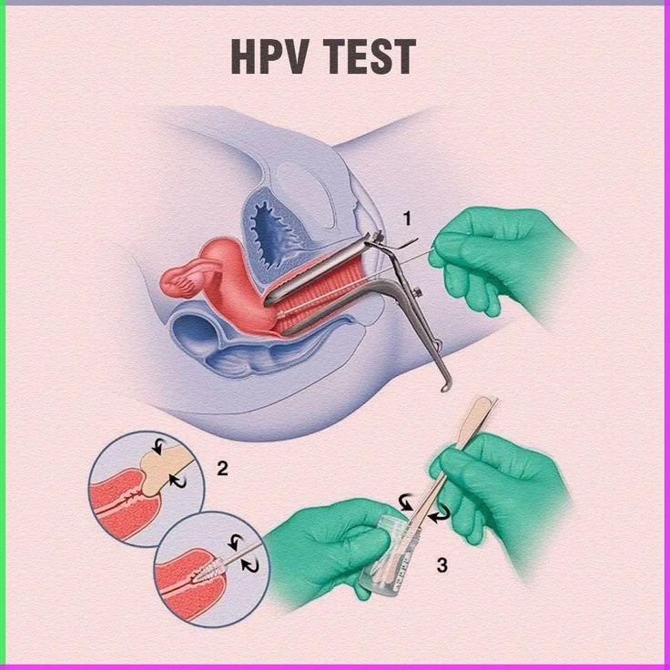 teste hpv
coleta de genotipagem hpv
coleta exame