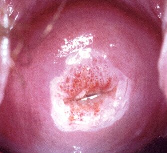 lesão intraepitelial cervical de alto grau
acetobranco
colo alterado