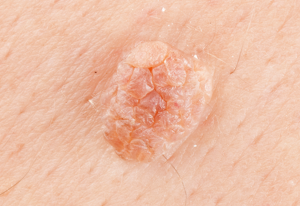 verruga genital
condiloma
lesão verrugosa benigna