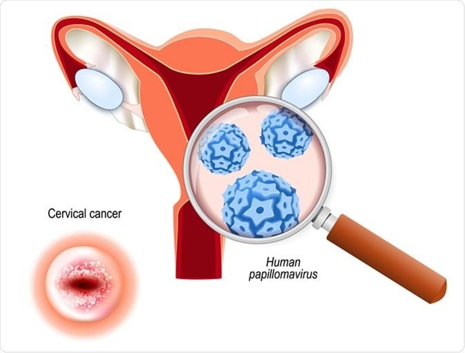 HPV
hpv
Papiloma vírus humano
câncer de colo do útero