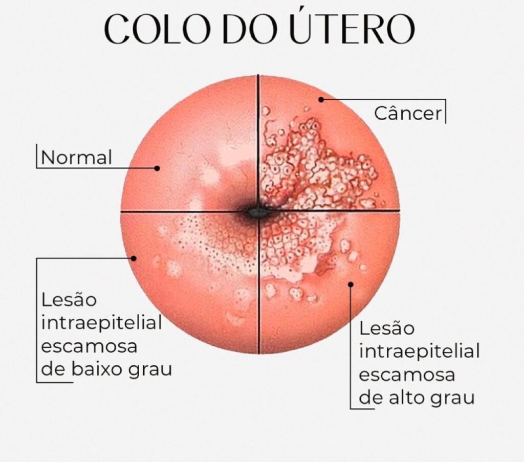 alterações no colo do útero
lesão de alto e baixo grau
câncer do colo do útero
colo do útero normal