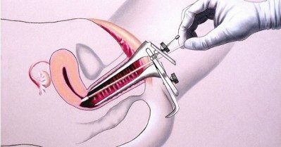 preventivo na menopausa
papanicolau na menopausa
exame de preventivo
