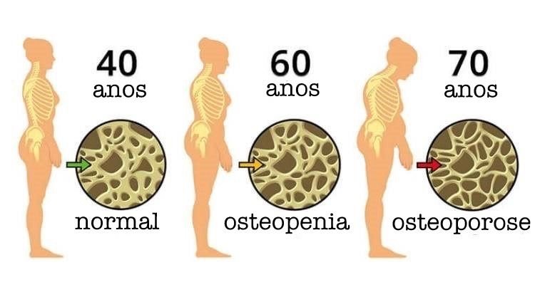 osteoporose
osteopenia
densitometria óssea
densitometria ossea
osso fraco
baixa de cálcio no osso
